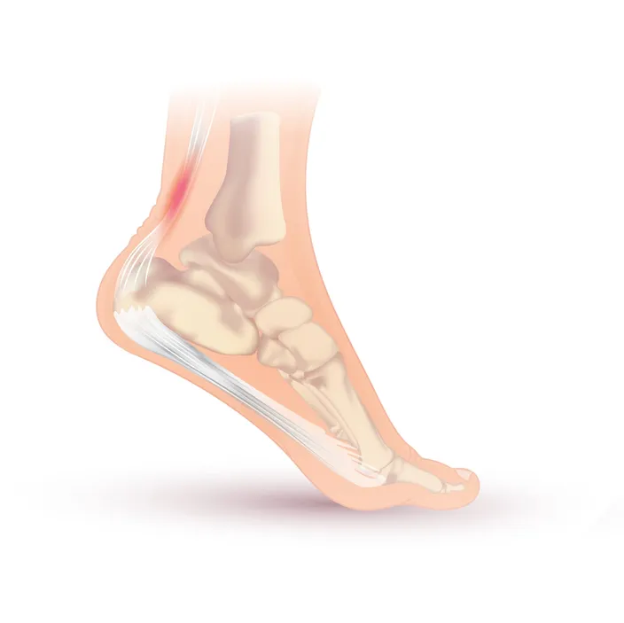Illustration of a foot and ankle from the side, heel raised, with the Achilles tendon at the back of the heel highlighted in red