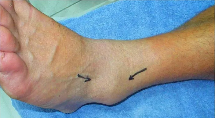 The outside of a swollen ankle with two arrows pointing to the swelling below the ankle bone