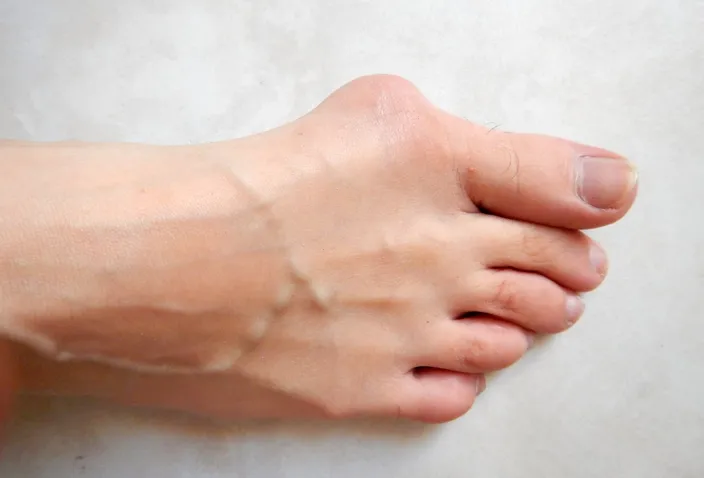 A bare foot seen from above with a bony bump at the base of the big toe and the big toe angled toward the second toe