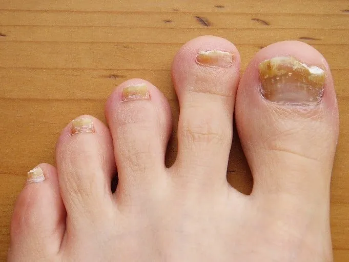 Toes on a wooden floor with several toenails that are thickened, yellow, and crumbling at the edges