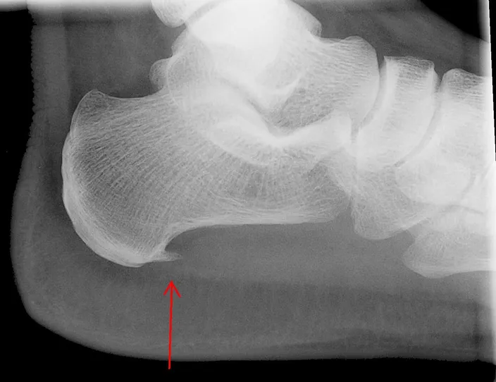 X-ray of a heel from the side with a red arrow pointing to a small bony spur projecting forward from the underside of the heel bone