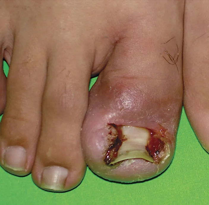 A big toe with the edge of the nail grown into the skin, which is red and swollen along that side of the nail