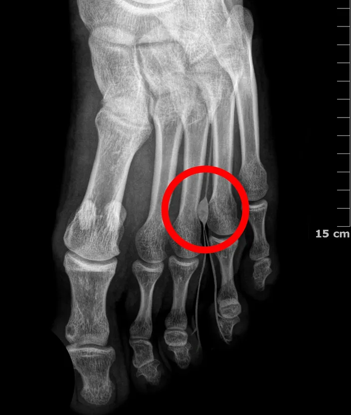 X-ray of a foot from above with a red circle drawn between the third and fourth toe bones, where a Morton's neuroma forms