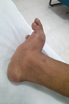 A patient's foot resting on a sheet