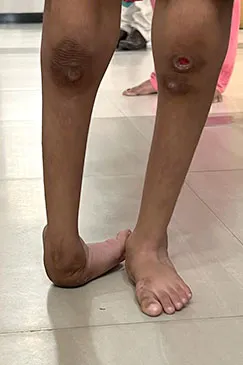 A patient's lower legs and feet, seen from the front