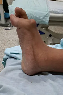 A patient's foot and ankle resting on a surgical drape