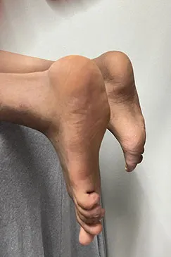 A close view of a patient's foot and ankle