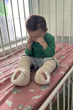 A young boy sitting on a bed with both legs in casts