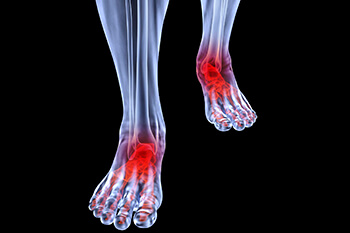 Arthritic foot and ankle care treatment, foot arthritis treatment in the San Antonio, TX 78224 and Uvalde, TX 78801 areas