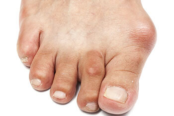Bunions treatment in the San Antonio, TX 78224, Uvalde, TX 78801 and Jourdanton, TX 78026 areas