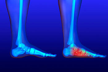 Flat feet and Fallen Arches treatment, Flatfoot Deformity Treatment in the San Antonio, TX 78224, Uvalde, TX 78801 and Jourdanton, TX 78026 areas