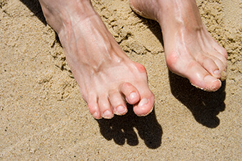 Hammertoes & Mallet Toes treatment in the San Antonio, TX 78224 and Uvalde, TX 78801 areas