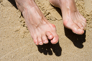 Hammertoes & Mallet Toes treatment in the San Antonio, TX 78224, Uvalde, TX 78801 and Jourdanton, TX 78026 areas