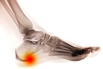 Heel spurs treatment in the San Antonio, TX 78224, Uvalde, TX 78801 and Jourdanton, TX 78026 areas