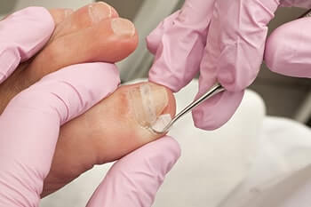 Ingrown toenails treatment in the San Antonio, TX 78224 and Uvalde, TX 78801 areas