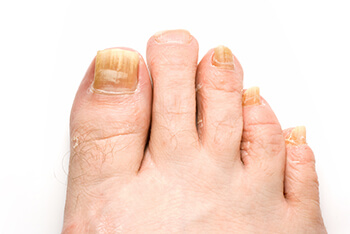 Fungal toenails diagnosis and treatment in the San Antonio, TX 78224, Uvalde, TX 78801 and Jourdanton, TX 78026 areas