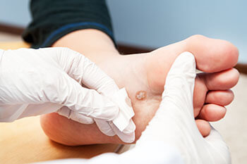 Plantar warts treatment in the San Antonio, TX 78224, Uvalde, TX 78801 and Jourdanton, TX 78026 areas