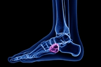 Examples of Developing Cuboid Syndrome