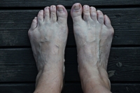 All About Bunions on the Pinky Toe