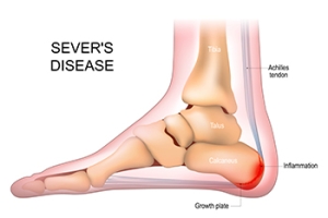 Heel Pain in Children