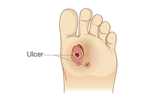 Caring for a Diabetic Foot Ulcer