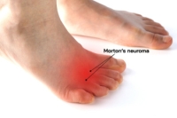 Exercises Can Ease Morton’s Neuroma Pain