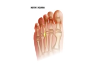 Common Symptoms of Morton's Neuroma
