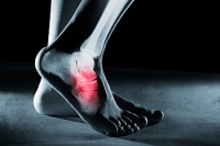 Symptoms of a Foot Stress Fracture
