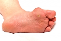 Foot Corns and Calluses
