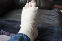When a Broken Foot Is Untreated