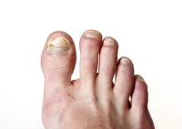 Managing Fungal Toenail Infections