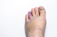 Treatment Methods for a Broken Toe