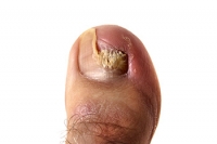 Medication and Toenail Fungus