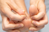 The Impact of Tinea Pedis