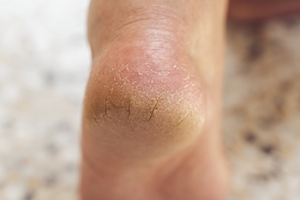 Getting Help for Painful Cracked Heels
