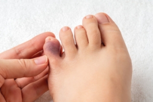 Finding Relief for a Broken Pinky Toe
