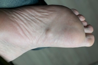 Plantar Fibromatosis and Its Impact on Foot Health